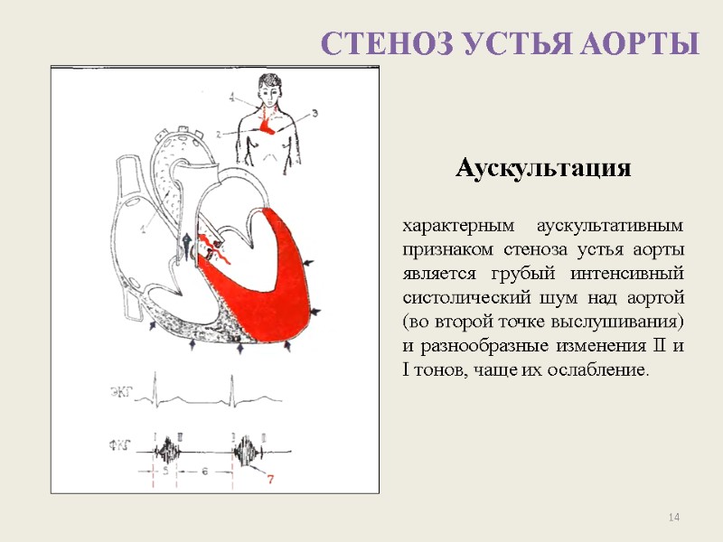 СТЕНОЗ УСТЬЯ АОРТЫ 14 Аускультация   характерным аускультативным признаком стеноза устья аорты является